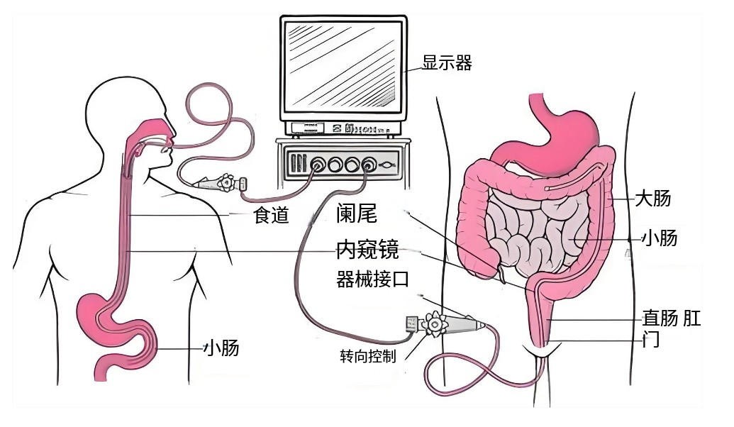 肠胃镜演示图